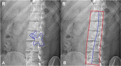 Lumbar X Ray Technique